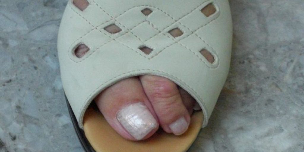 orthotic devices for hammertoes treatment